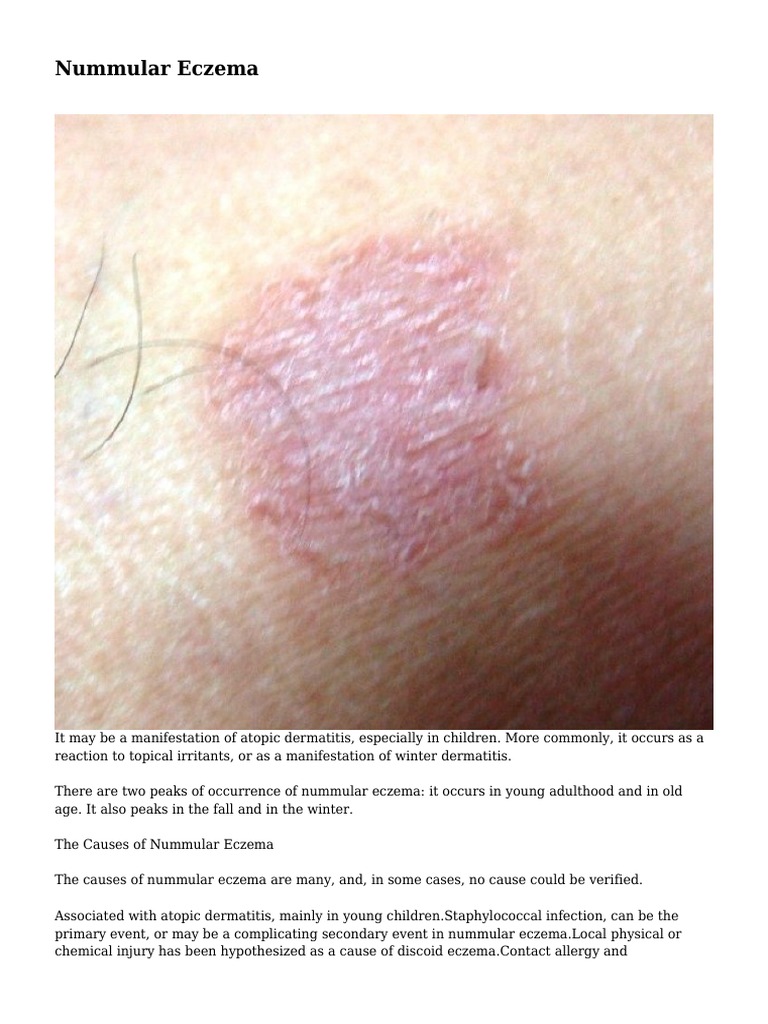 Nummular Eczema Dermatitis Psoriasis