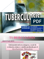 Tuberculosis