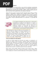 Infarto de Miocardio