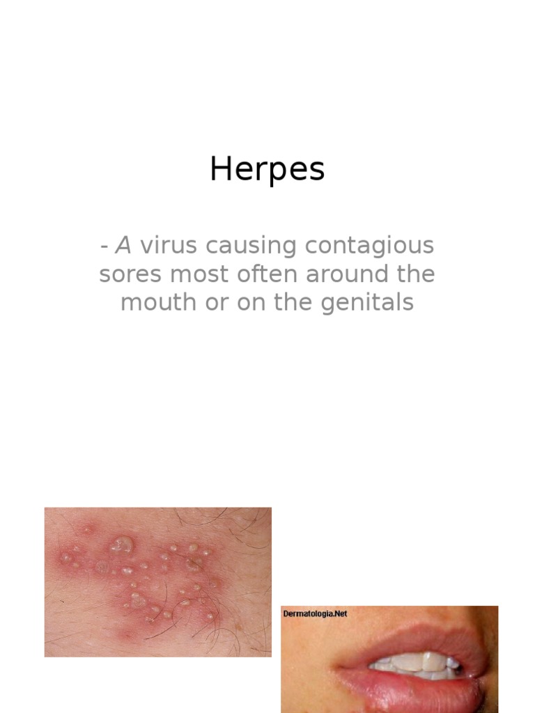 Herpes A Virus Causing Contagious Sores Most Often Around The Mouth