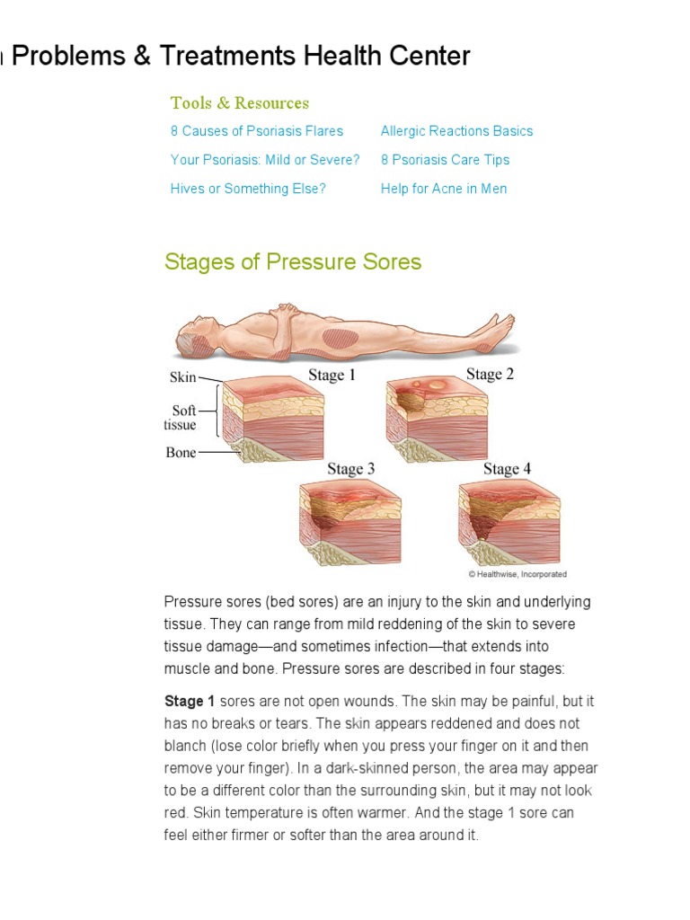 BED SORES Stages of Pressure Sores