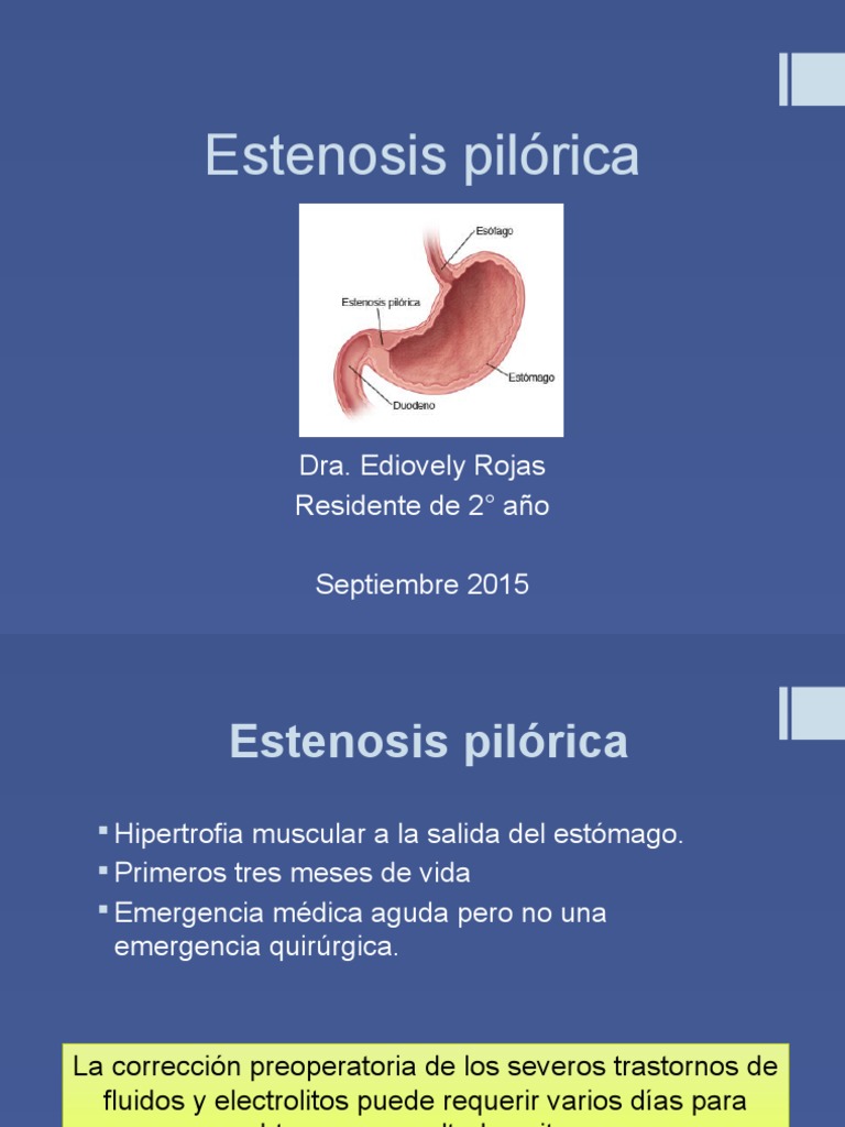 Estenosis Pilorica | PDF | Especialidades Medicas | Medicina CLINICA