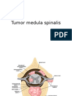 Tumor Medula Spinalis