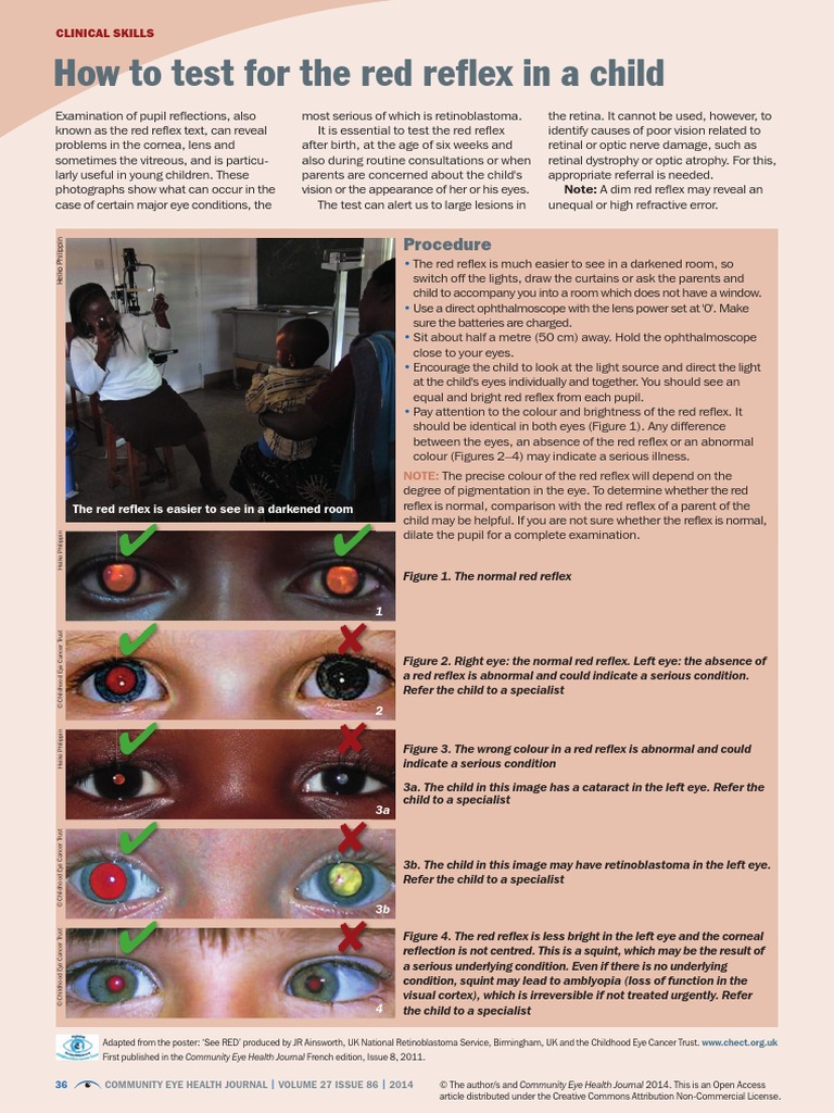 how-to-test-for-the-red-reflex-in-a-child-pdf-eye-retina