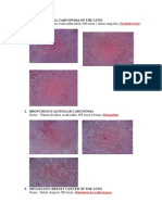 Squamous Cell Carcinoma of The Lung