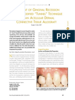 Treatment of Gingiva Recession With A Modified - Tunnel - Technique PDF
