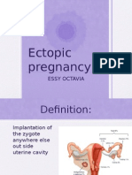 Ectopic Pregnancy: Essy Octavia