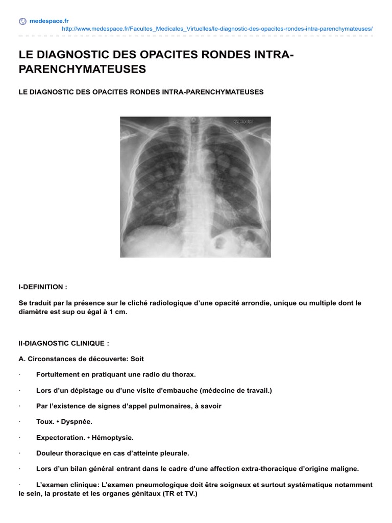 Diagnostic des opacités rondes pulmonaires | PDF | Cancer | Poumon