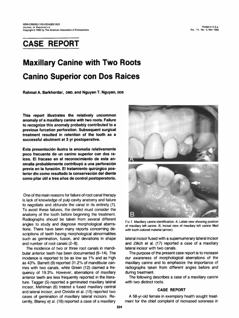 Maxillary Canine With Two Roots Dental Anatomy Tooth