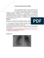 Teratoma Del Mediastino Anterior