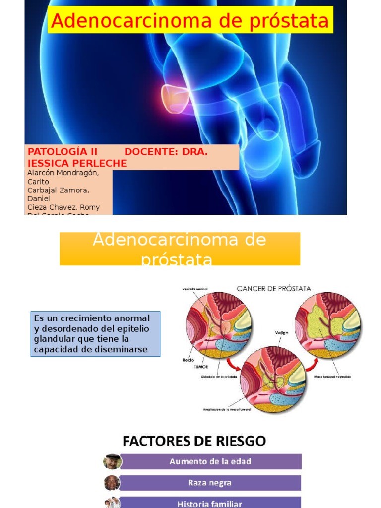 Adenocarcinoma de Próstata Antígeno específico de la próstata Cancer de prostata