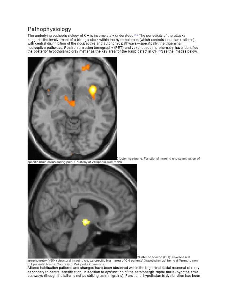 Pathophysiology of Cluster Headache Headache Hypothalamus