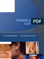 81465194 Tuberculosis Cutanea