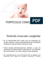 Torticolis Congenita