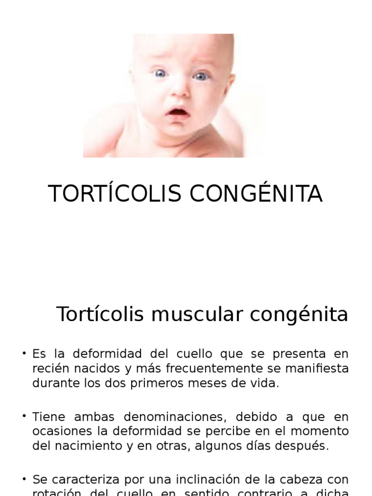 Torticolis Congenita
