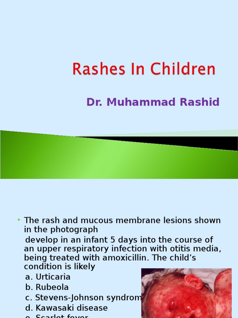 Stevens-Johnson Syndrome in Infants | PDF | Cutaneous Conditions ...