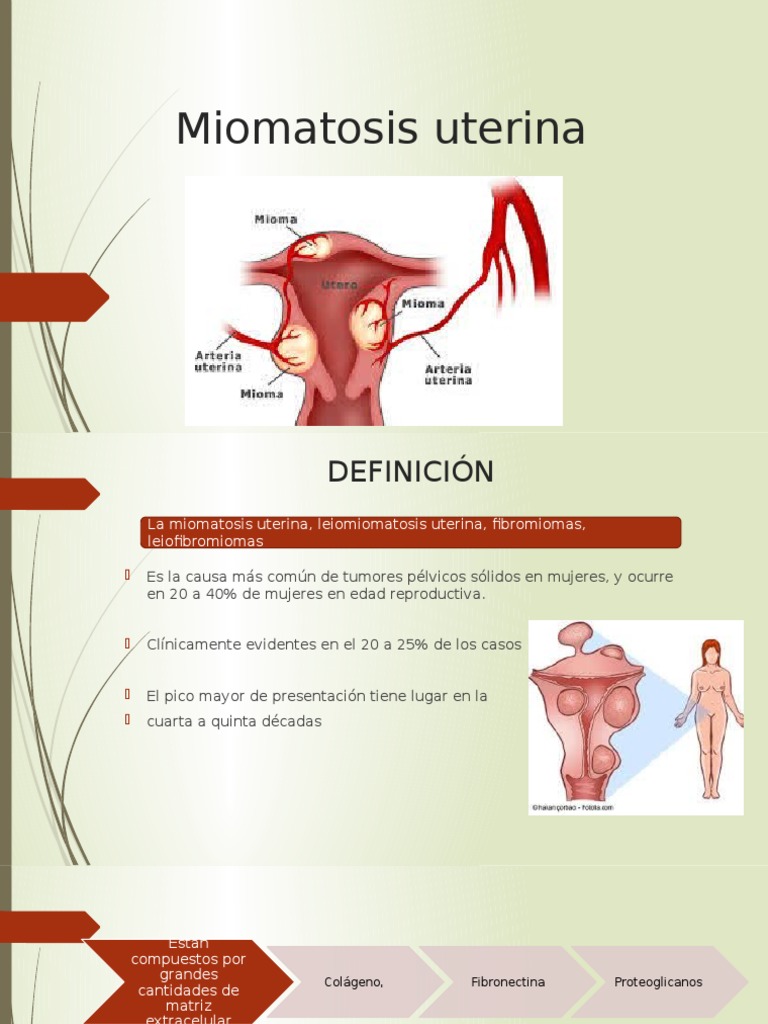 Miomatosis uterina | Útero | Neoplasias