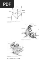 Colectomia Total PDF