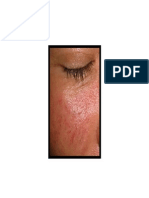 Rosacea Tratamiento, Como Eliminar La Rojez de La Rosacea, Enfermedad Rosacea, Como Tratar Rosacea