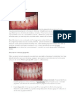 Ce Este Retracţia Gingivală