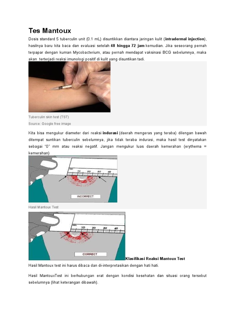 Panduan Lengkap Tes Mantoux TBC | PDF