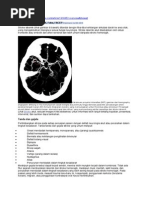 Download Stroke Iskemik by Yuny Hafitry SN289638008 doc pdf