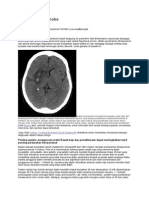 Hemorrhagic Stroke