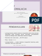 Laryngomalacia