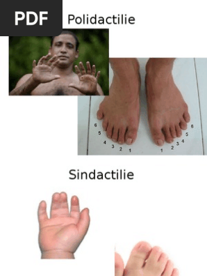 Maladii Genetice