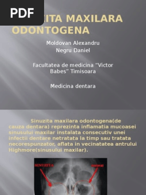 Sinuzita Maxilara Odontogena