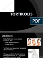 Tortikolis