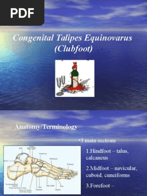 Clubfoot Presentation Pdf Foot Ankle