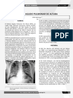 Edema Agudo Pulmonar de Altura