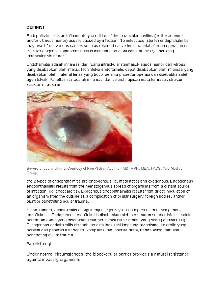 Understanding Endophthalmitis: A Comprehensive Review of the ...