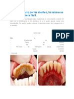 Elimina El Sarro de Tus Dientes