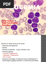 Leucemia Acuta Limfoblastica