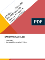 Gambaran Radiologi Pneumokoniosis