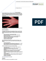 Dermatomyositis - Practice Essentials, Background, Pathophysiology