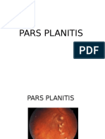 Pars Planitis Modified43