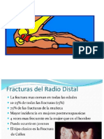 Fractura de Radio Distal