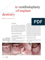 Up-To-Date at The Age of Implant Dentistry: Vestibuloplasty