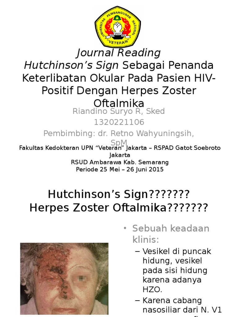 Hutchinson Sign as Marker of Ocular Involvement in HIV Positive