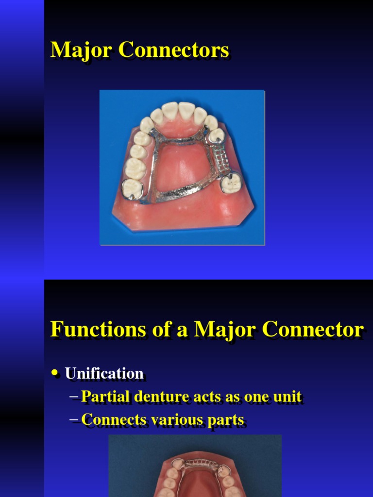Major Connectors IN RPD | PDF | Anatomical Terms Of Location | Dentures