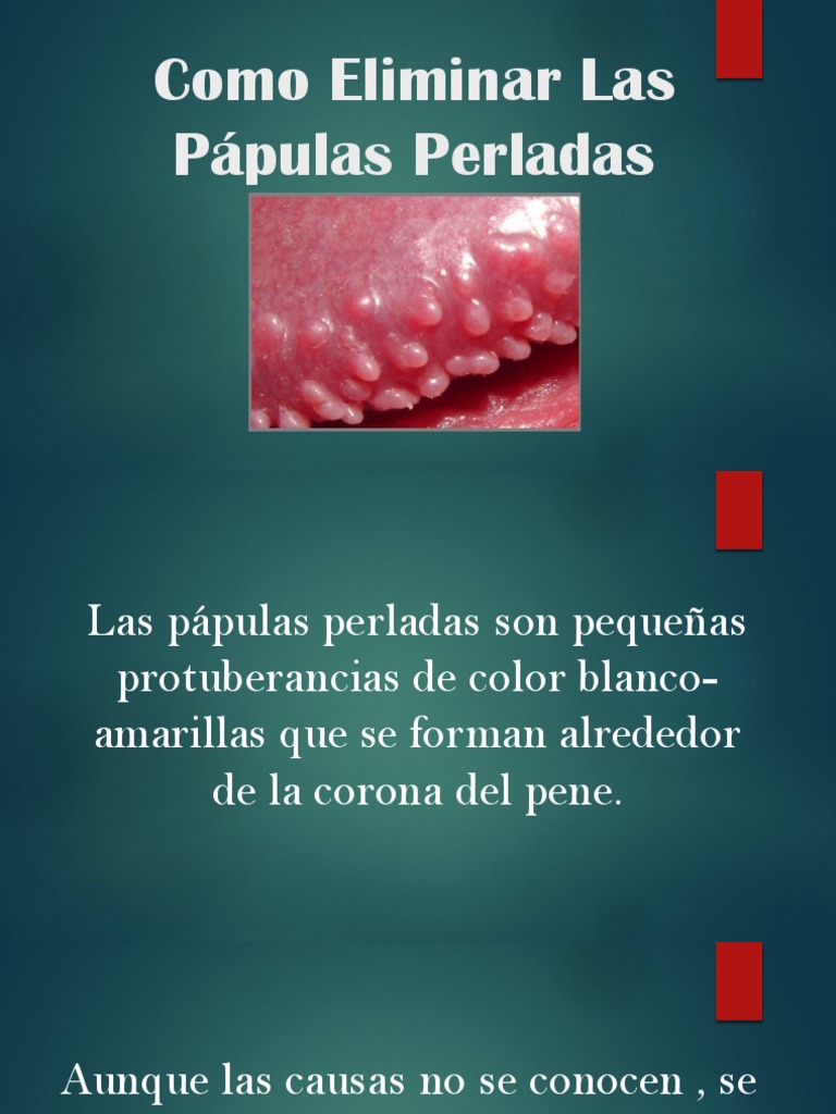Como Eliminar Las Pápulas Perladas PDF Salud pública Epidemiología
