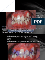 Gingivitis Puberal