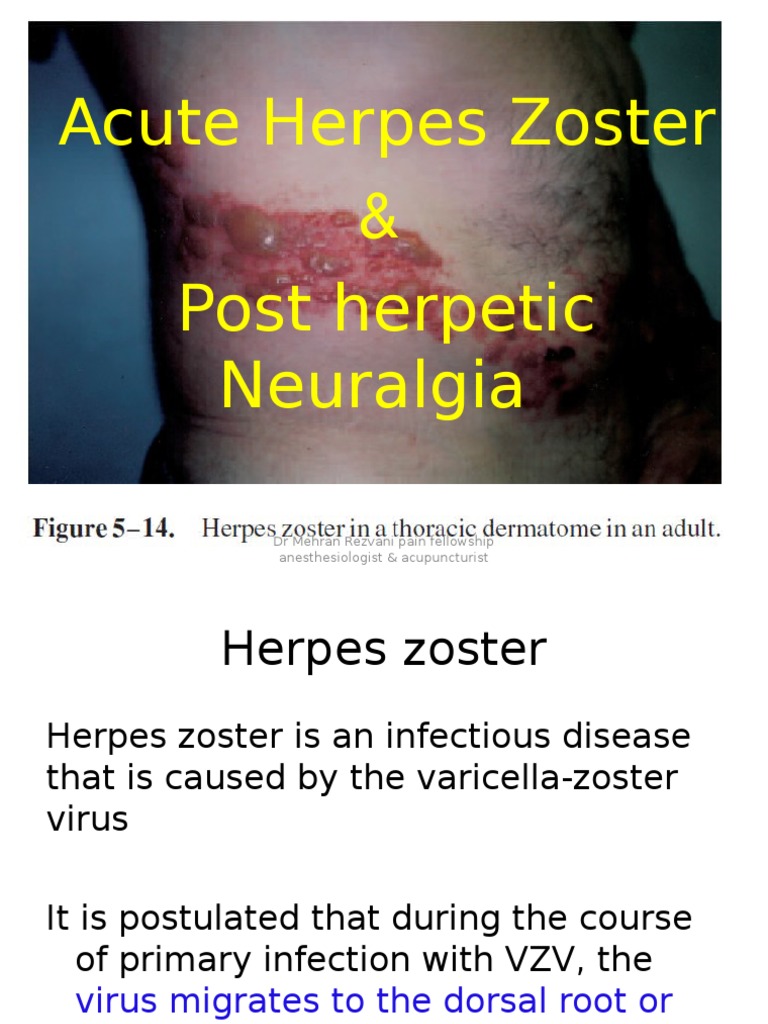 Post herpetic neuropathy icd 10