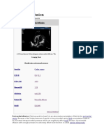 Pericardial Effusion Wikipedia