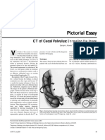 Cecal Volvulus - American Journal Roentgenology