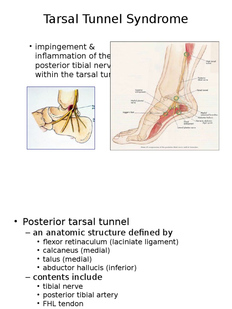 Tarsal Tunnel Syndrome