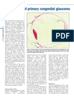 Glaucoma Article